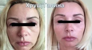 Носослізний борозна корекція способи корекції їх плюси і мінуси, фото до і після (борозна) Носослізний борозна корекція способи корекції їх плюси і мінуси, фото до і після
