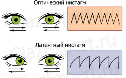 Ністагм очей що це, причини, види, діагностика і лікування (очей) Ністагм очей що це, причини, види, діагностика і лікування