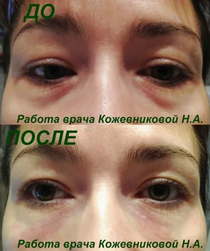 Нососльозова борозна хірургічні та хірургічні методи корекції (нососльозова) Нососльозова борозна хірургічні та хірургічні методи корекції