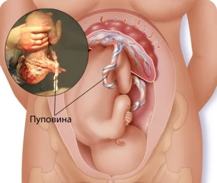 Обвиття пуповиною навколо шиї плода причини і наслідки, одноразове і багаторазове (пуповиною) Обвиття пуповиною навколо шиї плода причини і наслідки, одноразове і багаторазове