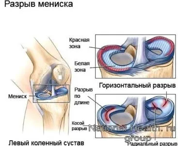 Операції на меніску артроскопія, меніскектомія, трансплантація (меніскектомія) Операції на меніску артроскопія, меніскектомія, трансплантація