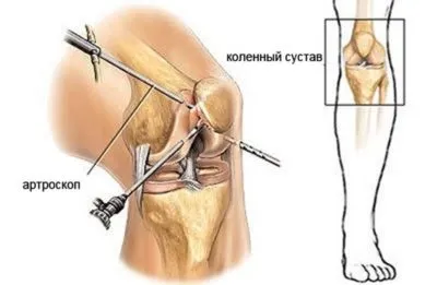 Операції на меніску артроскопія, меніскектомія, трансплантація (операції) Операції на меніску артроскопія, меніскектомія, трансплантація