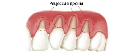 Оголення шийки зуба