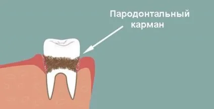 Оголення шийки зуба
