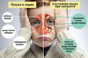 Особливості лікування набряку в носі причини і симптоми захворювання, способи лікування (носі) Особливості лікування набряку в носі причини і симптоми захворювання, способи лікування
