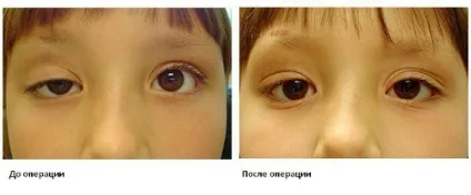 Особливості прихованого косоокості, про хвороби очей (лікування) Особливості прихованого косоокості, про хвороби очей