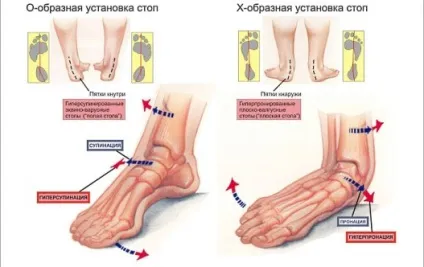 Ортопедичні устілки при плоскостопості які краще (плоскостопості) Ортопедичні устілки при плоскостопості які краще