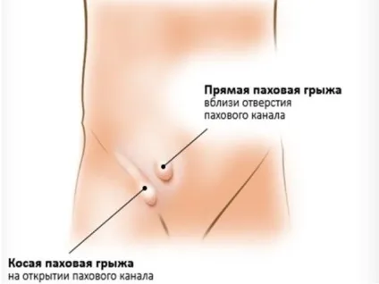 Пухлина в паху причини запалення лінфоузлов відео (причини) Пухлина в паху причини запалення лінфоузлов відео