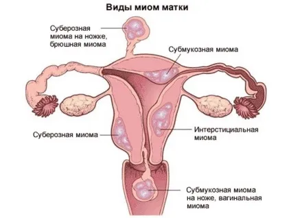 Як роблять узі матки і придатків