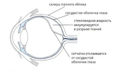 Опік сітківки ока симптоми і лікування (здорові очі) Опік сітківки ока симптоми і лікування