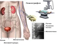 Пієлографія, мій уролог