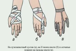 Перелом лучезапястного суглоба лікування і реабілітація, симптоми (відео) (суглоба) Перелом лучезапястного суглоба лікування і реабілітація, симптоми (відео)