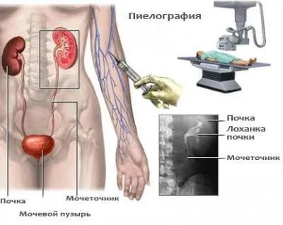 Пієлографія і уретеропіелографія внутрішньовенна, ретроградна, антеградная (внутрішньовенна) Пієлографія і уретеропіелографія внутрішньовенна, ретроградна, антеградная