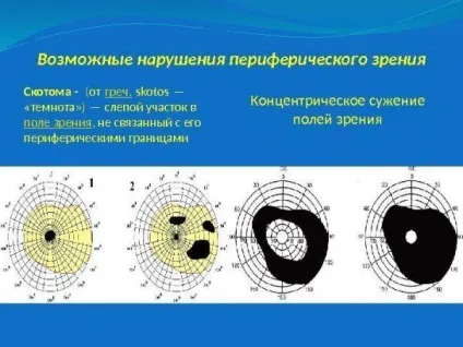 Периметрія очі - це комп'ютерна, статична розшифровка, дослідження полів зору, види, по
