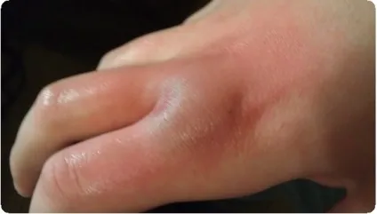 Чому опухла і болить рука причини, наслідки (причини) Чому опухла і болить рука причини, наслідки