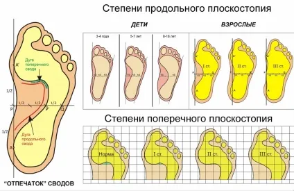 Плоскостопість наслідки для організму