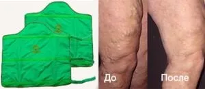 Подушка варіфорт від варикозу лікувальні якості, ціна, відгуки (лікувальні) Подушка варіфорт від варикозу лікувальні якості, ціна, відгуки