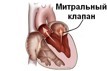 Майже безпечний порок серця - мітральний - і його лікування (порок) Майже безпечний порок серця - мітральний - і його лікування