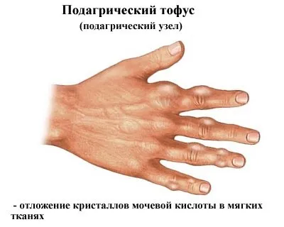 Подагра ознаки і лікування фото у дорослих, народні способи