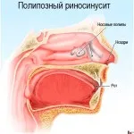 Поліпозно риносинусит симптоми і лікування (утворень носових проходах) Поліпозно риносинусит симптоми і лікування