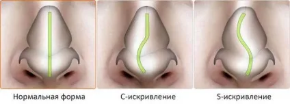 Поліпозно риносинусит причини, симптоми і способи лікування (риносинусит) Поліпозно риносинусит причини, симптоми і способи лікування
