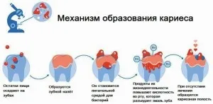 Поверхневий карієс - лікування та діагностика з фото у дітей і дорослих (діагностика) Поверхневий карієс - лікування та діагностика з фото у дітей і дорослих
