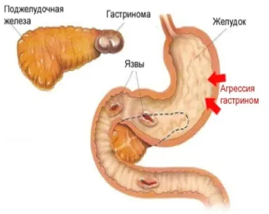 Підвищена кислотність шлунка симптоми і її основні причини (підвищеної кислотності шлунка) Підвищена кислотність шлунка симптоми і її основні причини