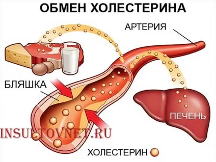 Повторний інсульт як уникнути нападу (нападу) Повторний інсульт як уникнути нападу