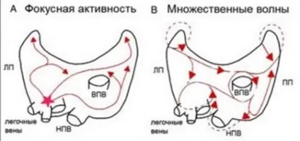 передсердна екстрасистолія