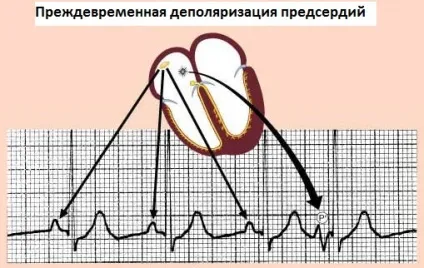Передчасна деполяризація передсердь, передчасна деполяризація шлуночків (передчасна деполяризація шлуночків лікування) Передчасна деполяризація передсердь, передчасна деполяризація шлуночків