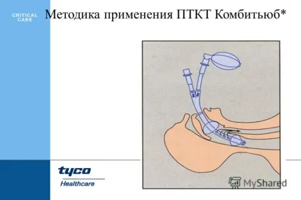 Презентація на тему combitube - для важких і екстрених інтубацій (combitube ® для важких і екстрених інтубацій. Вперше впроваджена в 1987 р професором michael frass з університетській клініці вени) Презентація на тему combitube - для важких і екстрених інтубацій