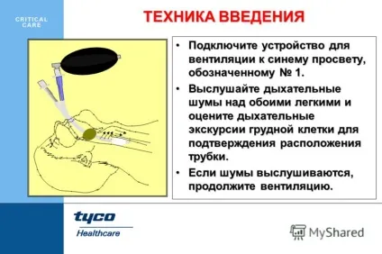 Презентація на тему combitube - для важких і екстрених інтубацій (combitube) Презентація на тему combitube - для важких і екстрених інтубацій