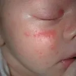 Причини висипу на обличчі від захворювань до неправильного харчування (захворювань) Причини висипу на обличчі від захворювань до неправильного харчування
