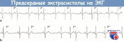 Ознаки передсердної екстрасистолії на ЕКГ (ознаки) Ознаки передсердної екстрасистолії на ЕКГ