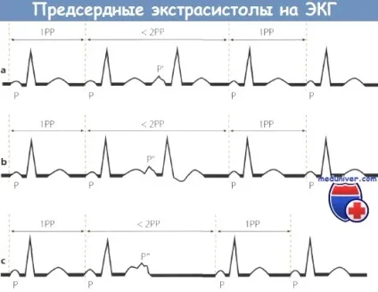 Ознаки передсердної екстрасистолії на ЕКГ (ознаки передсердної екстрасистолії на ЕКГ) Ознаки передсердної екстрасистолії на ЕКГ