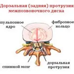 Протрузія диска l4 l5 - що це таке, симптоми, види, причини, лікування протрузії