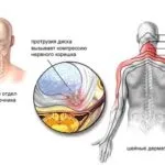 Протрузія диска l4 l5 - що це таке, симптоми, види, причини, лікування протрузії