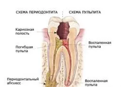 Пульсуючий біль в зубі