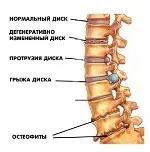 Радикуліт - види, симптоми, лікування, причини, діагностика