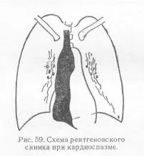 Розширення стравоходу, довідник лікаря (стравоходу) Розширення стравоходу, довідник лікаря