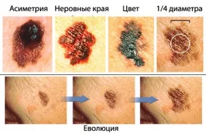 Ракова родимка - меланома ознаки і небезпеки, фото (раптом переродиться влітку) Ракова родимка - меланома ознаки і небезпеки, фото