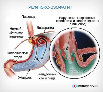 Рефлюкс-езофагіт симптоми і лікування (симптоми) Рефлюкс-езофагіт симптоми і лікування