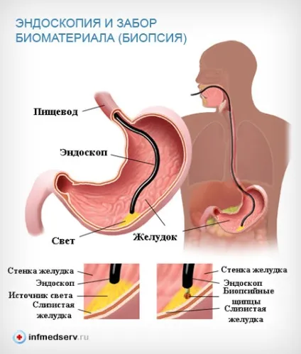 Рефлюкс-езофагіт симптоми і лікування (рефлюкс-езофагіт) Рефлюкс-езофагіт симптоми і лікування