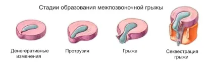 Сайт про лікування і здоров'я хребта (диска починає виступати межі) Сайт про лікування і здоров'я хребта
