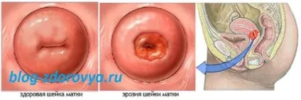 Шишка на шийці матки