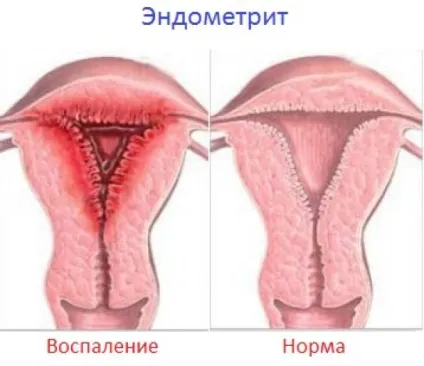 Симптоми і лікування хронічного та післяпологового ендометриту, ідеальна я (форма післяпологового ендометриту) Симптоми і лікування хронічного та післяпологового ендометриту, ідеальна я