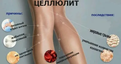 Як позбутися целюліту 1 (позбутися) Як позбутися целюліту 1