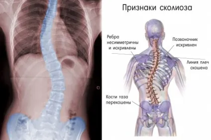 Сколіоз у дітей корисна інформація для батьків (дитячі хвороби) Сколіоз у дітей корисна інформація для батьків