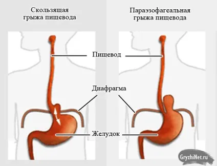 Змінна грижа стравохідного отвору діафрагми причини, симптоми, лікування (стравохідного) Змінна грижа стравохідного отвору діафрагми причини, симптоми, лікування