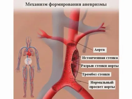 Сонна артерія на шиї у людини її хвороби (хвороби) Сонна артерія на шиї у людини її хвороби